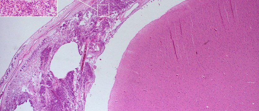 Wzrost zachorowań na zapalenie opon mózgowo-rdzeniowych